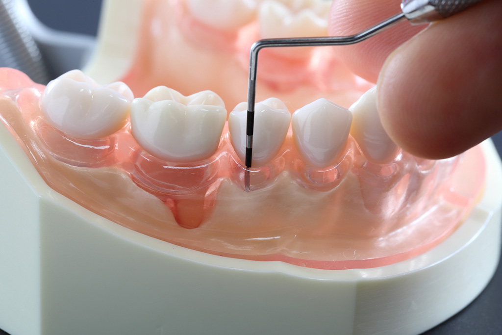 歯周組織検査(再評価)