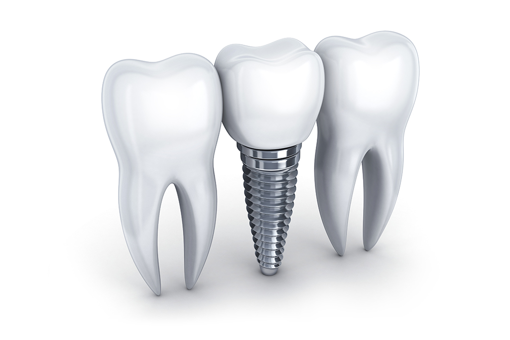 「インプラント」は自分の歯のような使い心地の義歯