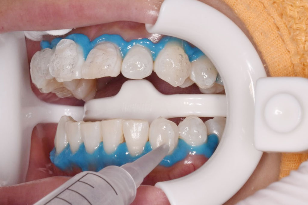 歯ぐきの保護